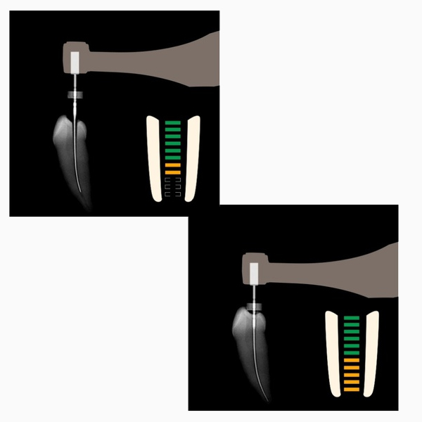 MOTOR ENDODONCIA - ENDO RADAR - WOODPECKER